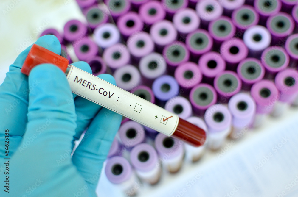 Obraz premium Blood sample with MERS-CoV (Middle East respiratory syndrome coronavirus) positive