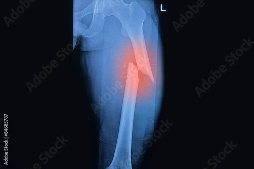 Slika na platnu Fractured Femur, Broken thigh x-rays image