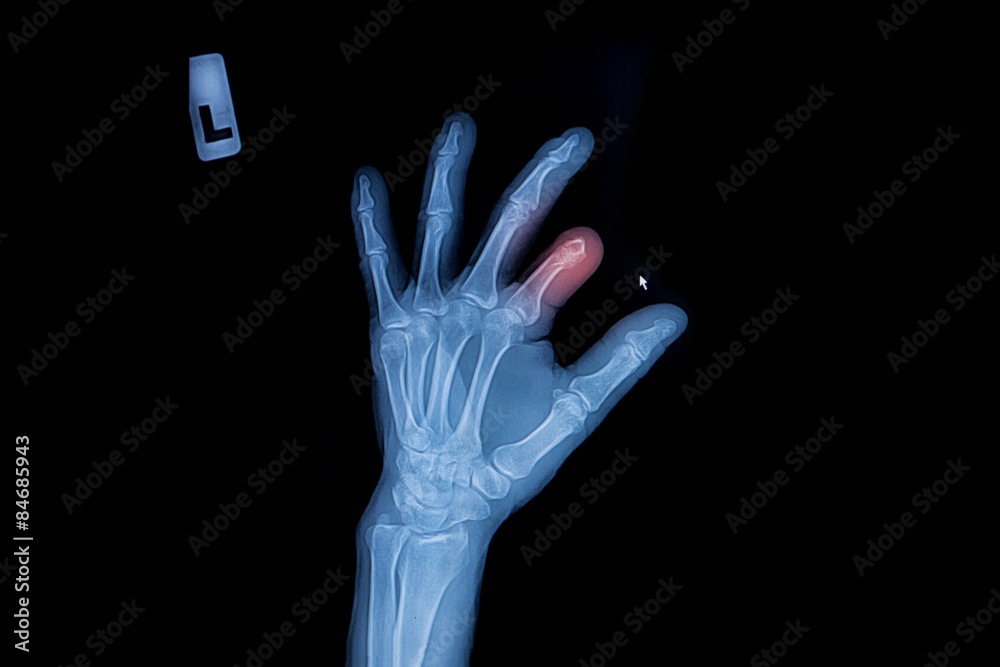 X-ray of trauma hand and finger