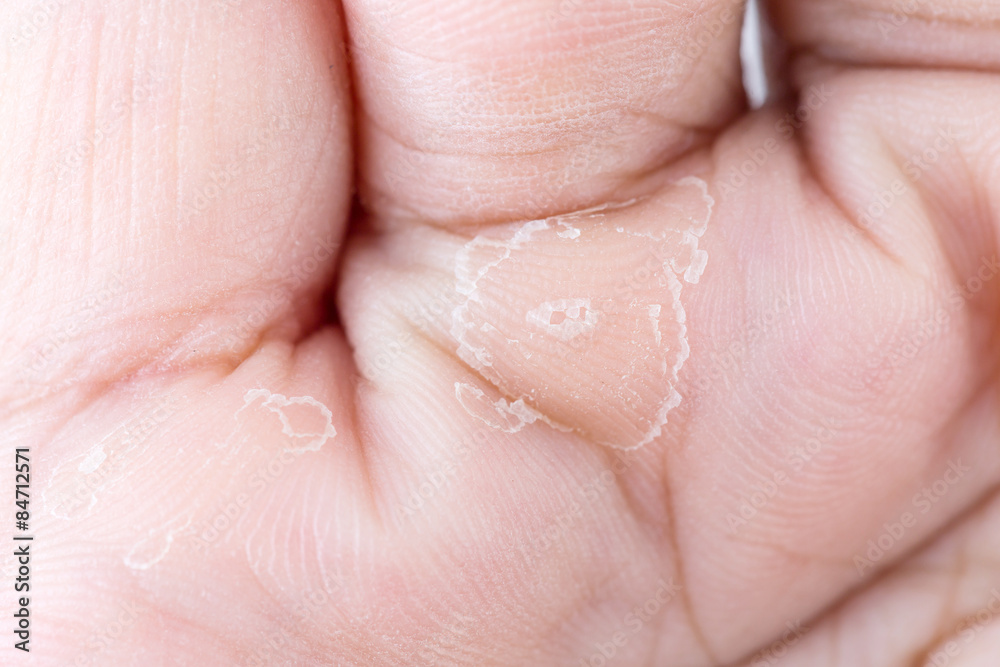 Close up peeling on hand Close up peeling on hand