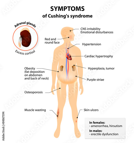Cushing’s disease and syndrome