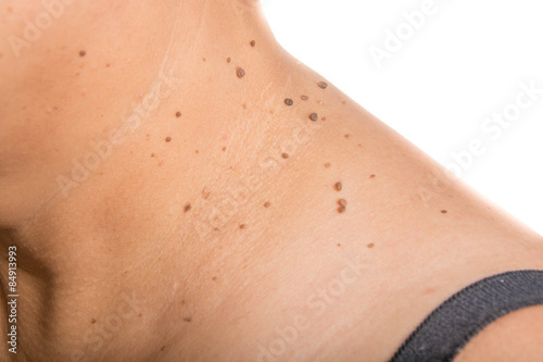 skin of a woman with moles
