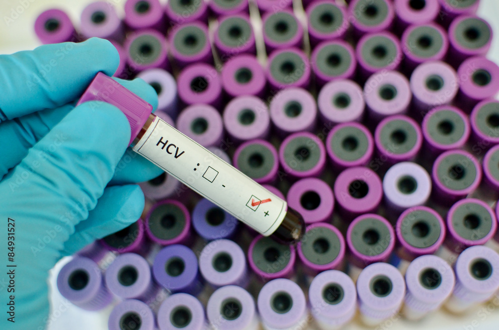 Fototapeta premium Hepatitis C virus positive