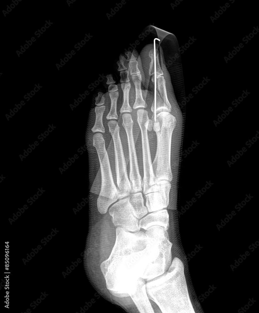 film x-ray show fracture proximal phalange at first toe