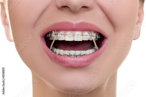 Closeup Braces on Teeth with Elastics. Orthodontic Treatment. Front View Dental Brackes.
