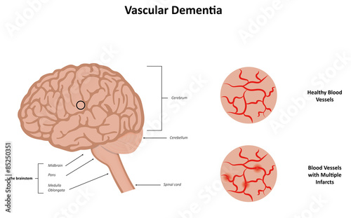 Vascular Dementia