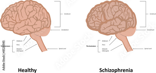 Schizophrenia