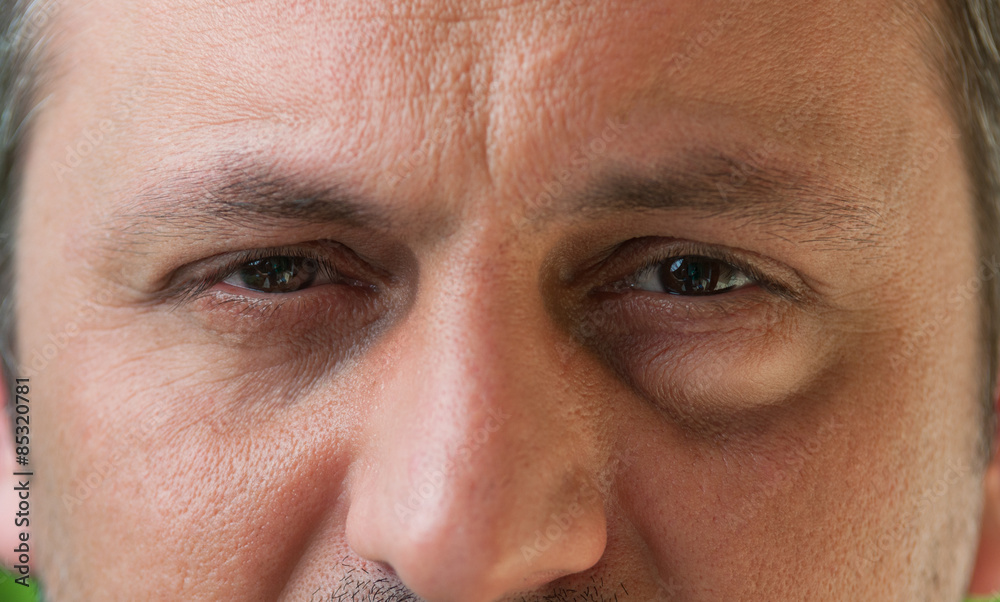 Fototapeta premium One eye with conjunctivitis