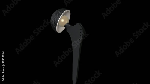 3D medical animation of a total hip replacement (endoprosthesis)