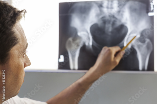 Doctor pointing at x-ray of a pelvis