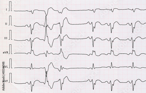 Tableau sur toile ECG with myocardial infarction and pair ventricular beats