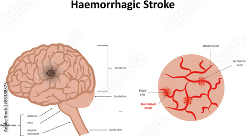 Haemorrhagic Stroke