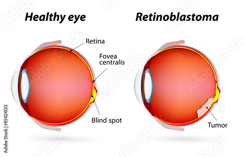 Retinoblastoma