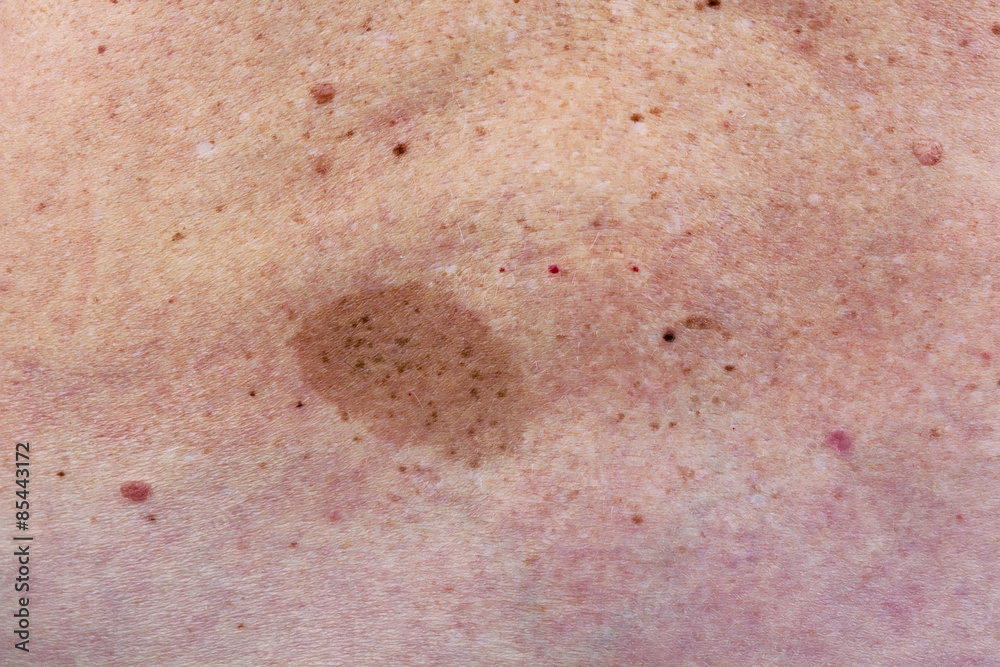 Fototapeta premium Big birthmark on woman back