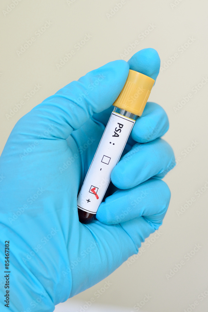 Obraz premium Blood sample with PSA (Prostate-specific antigen) positive