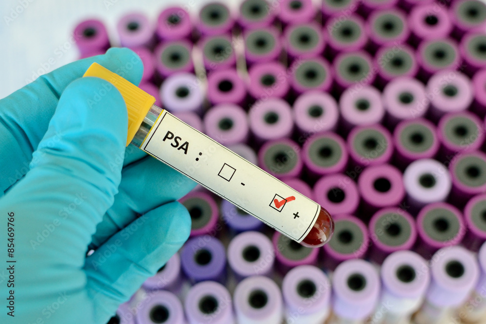Obraz premium Blood sample with PSA (Prostate-specific antigen) positive