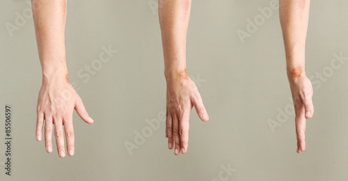 Close up view of nasty wounds on wrist from different angles