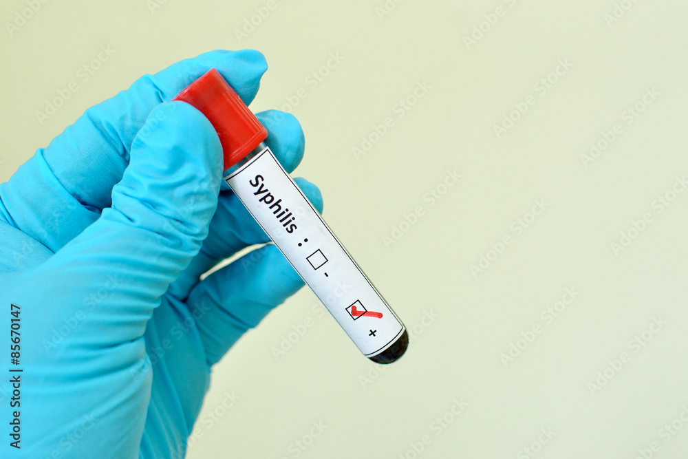 Fototapeta premium Blood sample with syphilis (Treponema Pallidum) positive