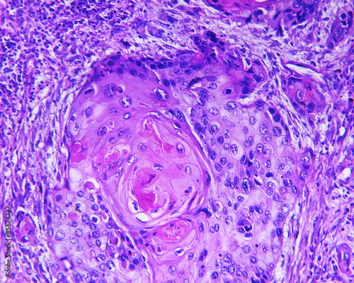 Billede på lærred Squamous cell carcinoma of a human