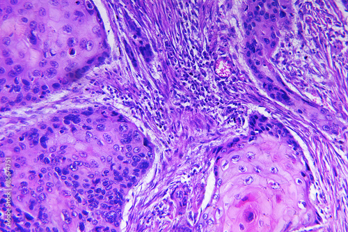 Squamous cell carcinoma of a human