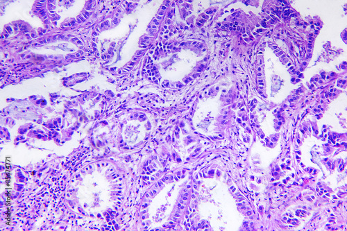 Well differentiated adenocarcinoma of a human