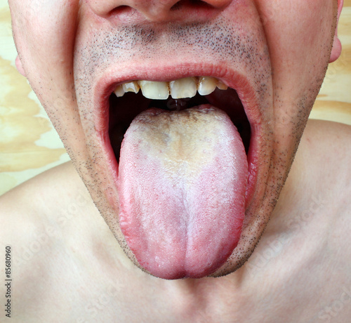Quadro su tela Infection tongue