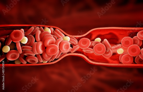 blood clot photo