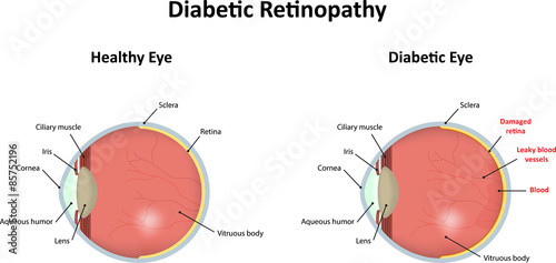 Diabetic Retinopathy