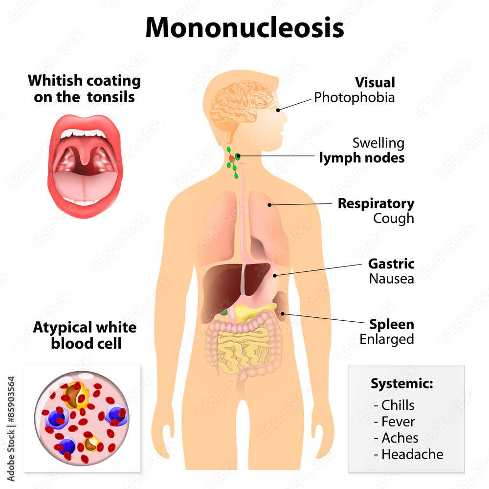 infectious mononucleosis - obrazy, fototapety, plakaty 
