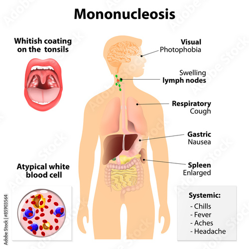 infectious mononucleosis photo