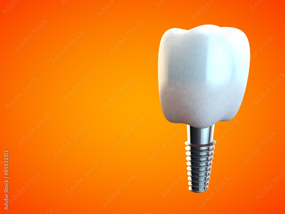 Tooth molar implant Dental Hygiene Dentist 3D orange Tooth molar implant Dental Hygiene Dentist 3D orange