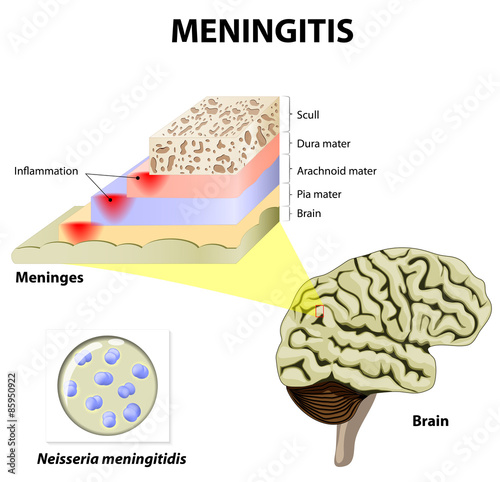 Meningitis photo