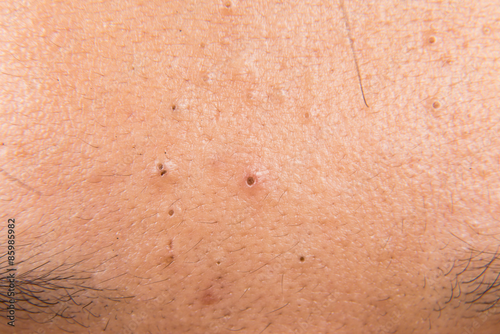 Close up on pimples, acne, zit and blackheads on forehead of a teenager