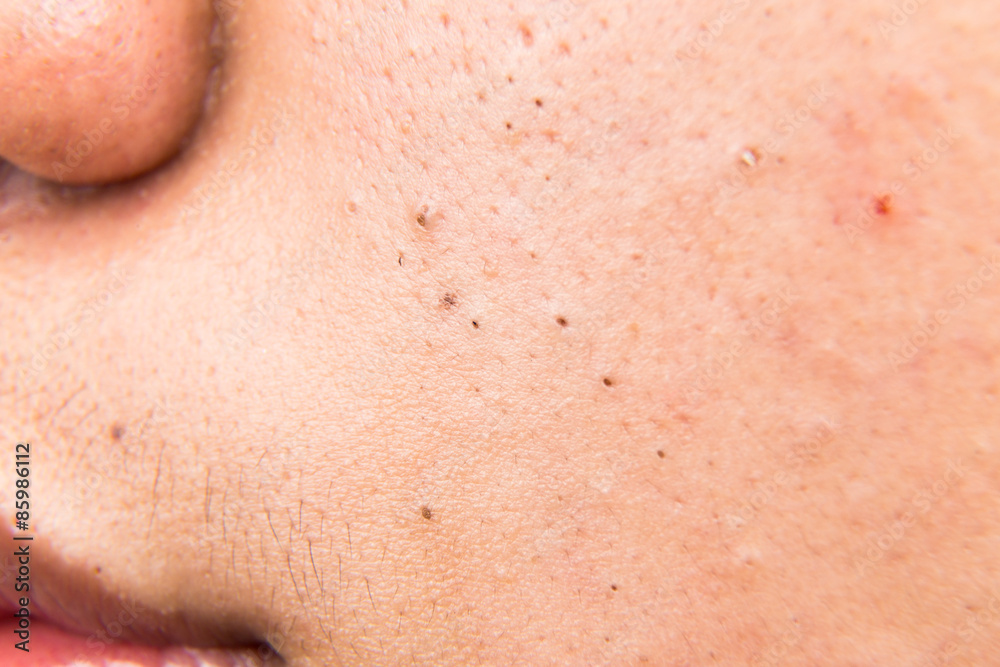 Close up on ugly acne, pimples, zit, blackheads on cheek of a teenager