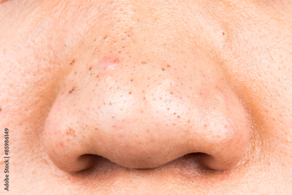 Ugly pimples, acne, zit and blackheads on the nose of a teenager