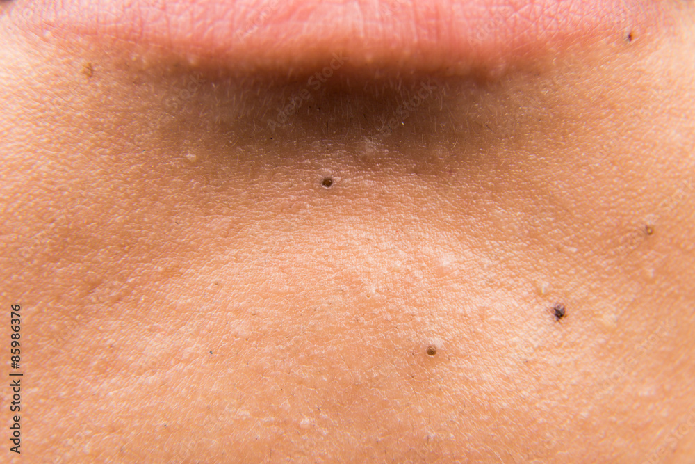 Lip blackheads 2024