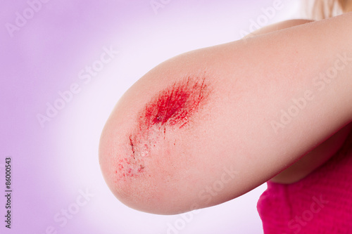 Schürfwunde am Ellbogen