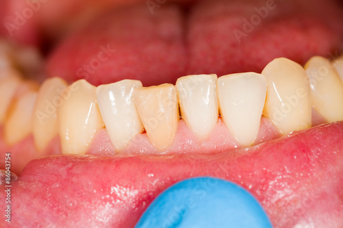 Incisors as Subject of Dental Photography