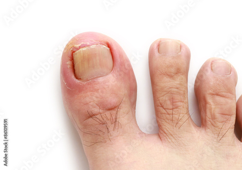 Ingrown toenail isolated on white background photo