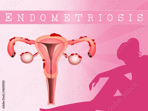 endometriosis photo