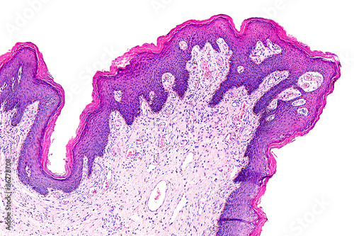 Skin papilloma of a human, highly detailed segment of panorama. Photomicrograph as seen under the microscope, 10x zoom. photo