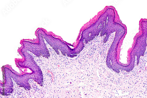 Skin papilloma of a human, highly detailed segment of panorama. Photomicrograph as seen under the microscope, 10x zoom.