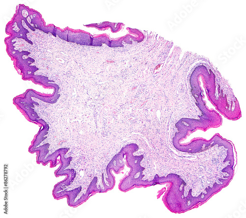 Skin papilloma of a human, highly detailed panorama. Photomicrograph as seen under the microscope, 10x zoom.