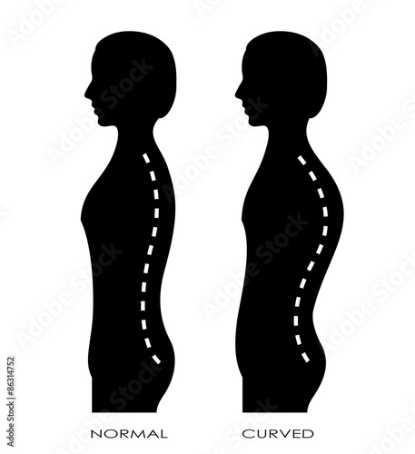 Spinal curvature