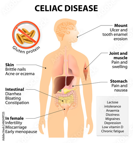 Coeliac disease or celiac disease photo