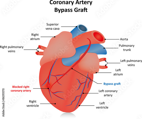 Obraz na płótnie Coronary Artery Bypass Graft
