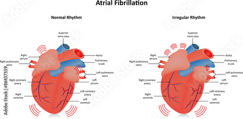 Atrial Fibrillation photo