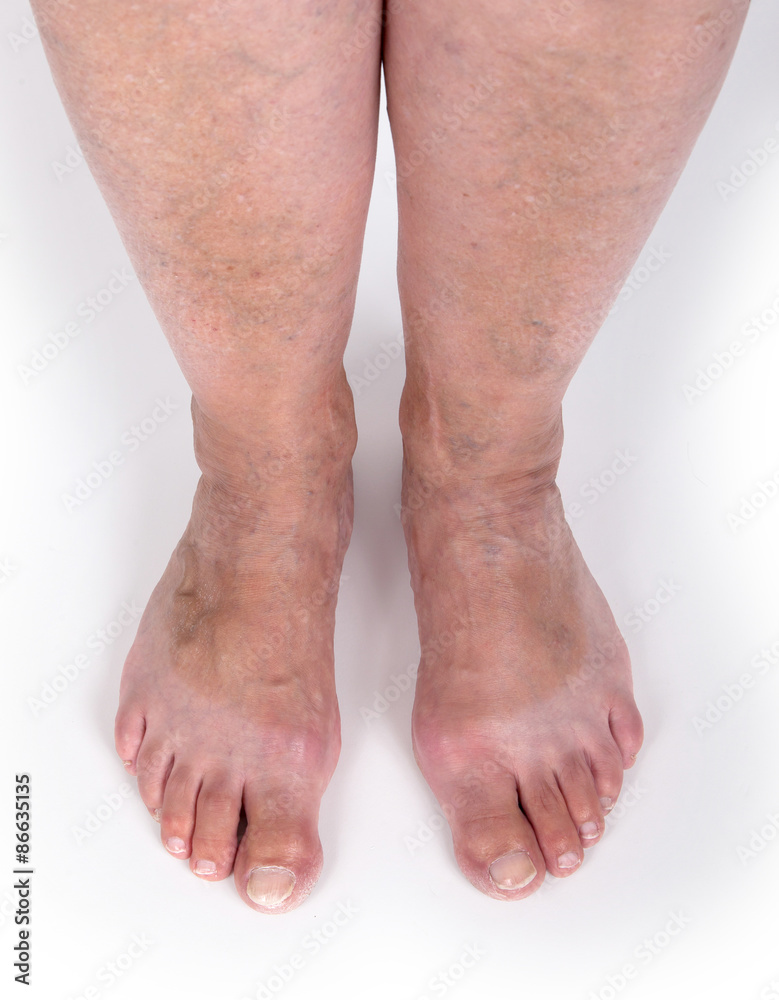Old woman with varicose veins