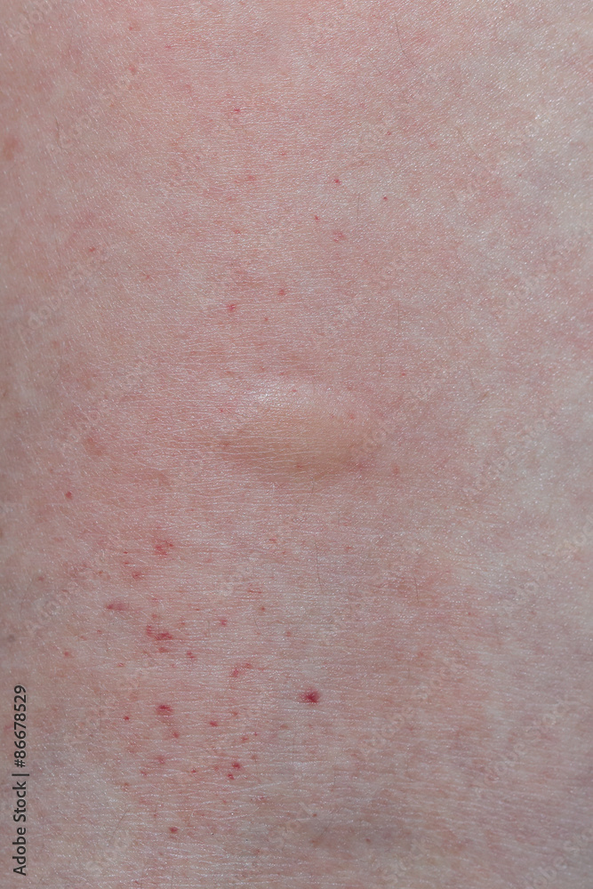 mosquito bites on a leg mosquito bites on a leg