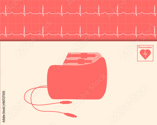 Red silhouette pacemaker and cardiogram background.